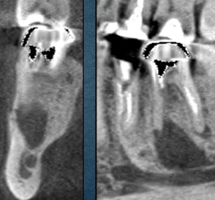Asymptomatic periodontitis case in 2012 showed a large radiolucency.