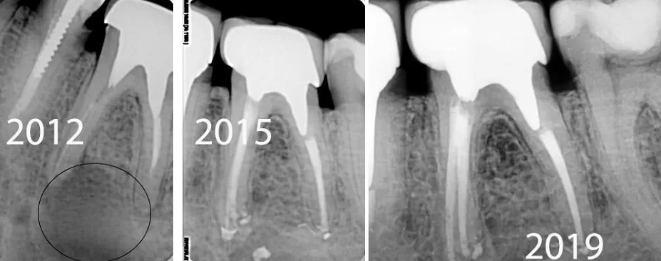 Post-treatment image in 2012 shows bone defect, completely healed by 2015 3-year follow-up.