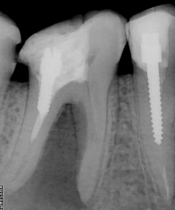 Extensive apical bone loss from apical periodontitis often necessitates extraction, despite lesion size not being decisive.