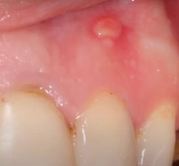Fistulas secondary to apical periodontitis can mistakenly suggest extraction instead of endodontic treatment.