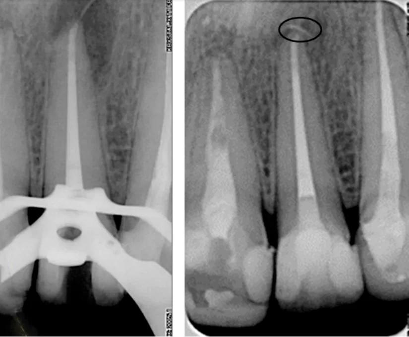 Endodontic treatment, restoration, and localized treatment resulted in near complete bony healing, right image.