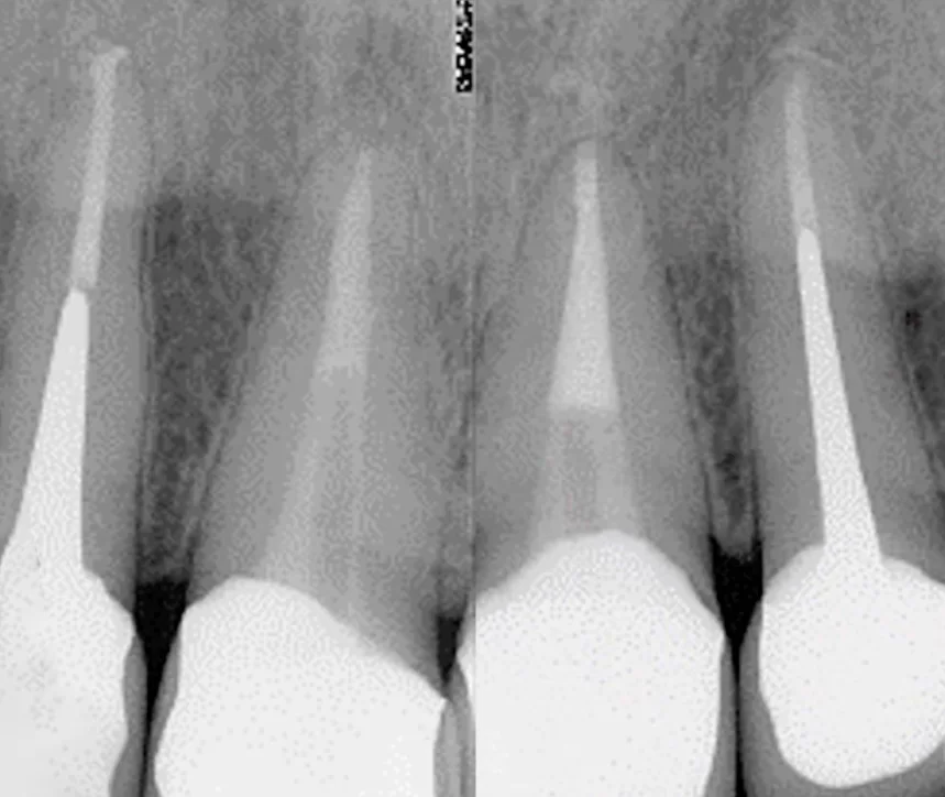 Treated root canals require sealing and full-coverage crowns for restoration.