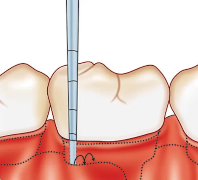 Periodontal probing is a standard diagnostic technique taught universally.