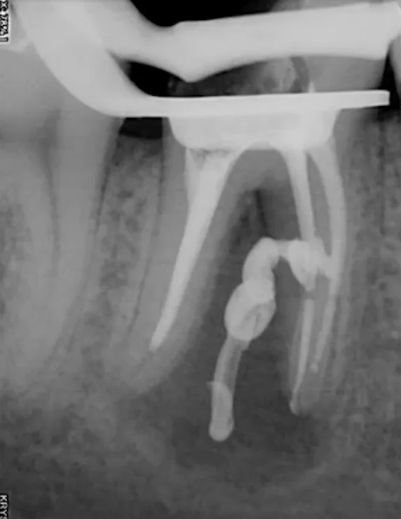 Radiograph revealed communication between root canal and interradicular space.