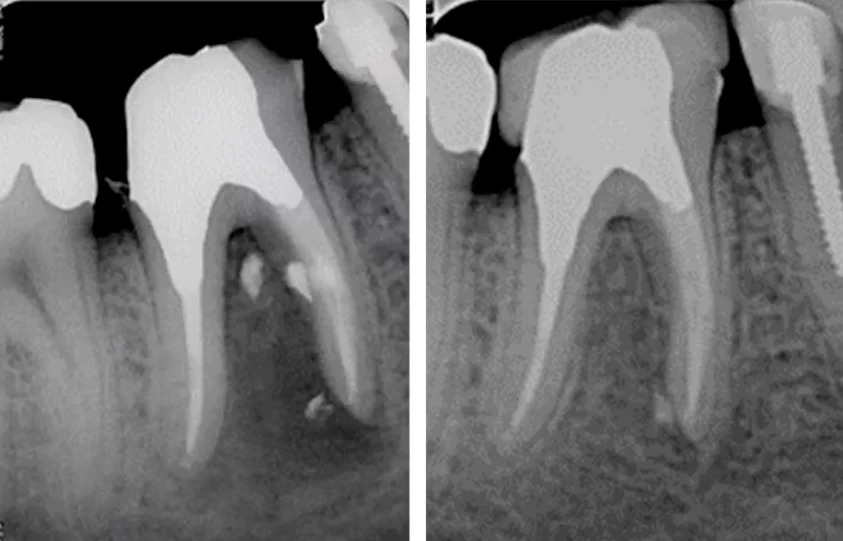 Root canal therapy completed august 2010 with amalgam core and temporary crown placed september 2010, left image.