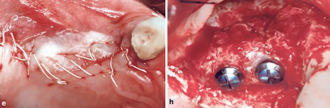 Pictures at different stages on the left sutured flap immediately after placing the membrane, on the right the opened flap where you can see a significant increase in bone tissue.