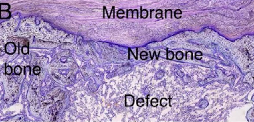 Guided bone regeneration (gbr). Membrane. Part 1 guided bone regeneration gbr. Part i. Membrane 20