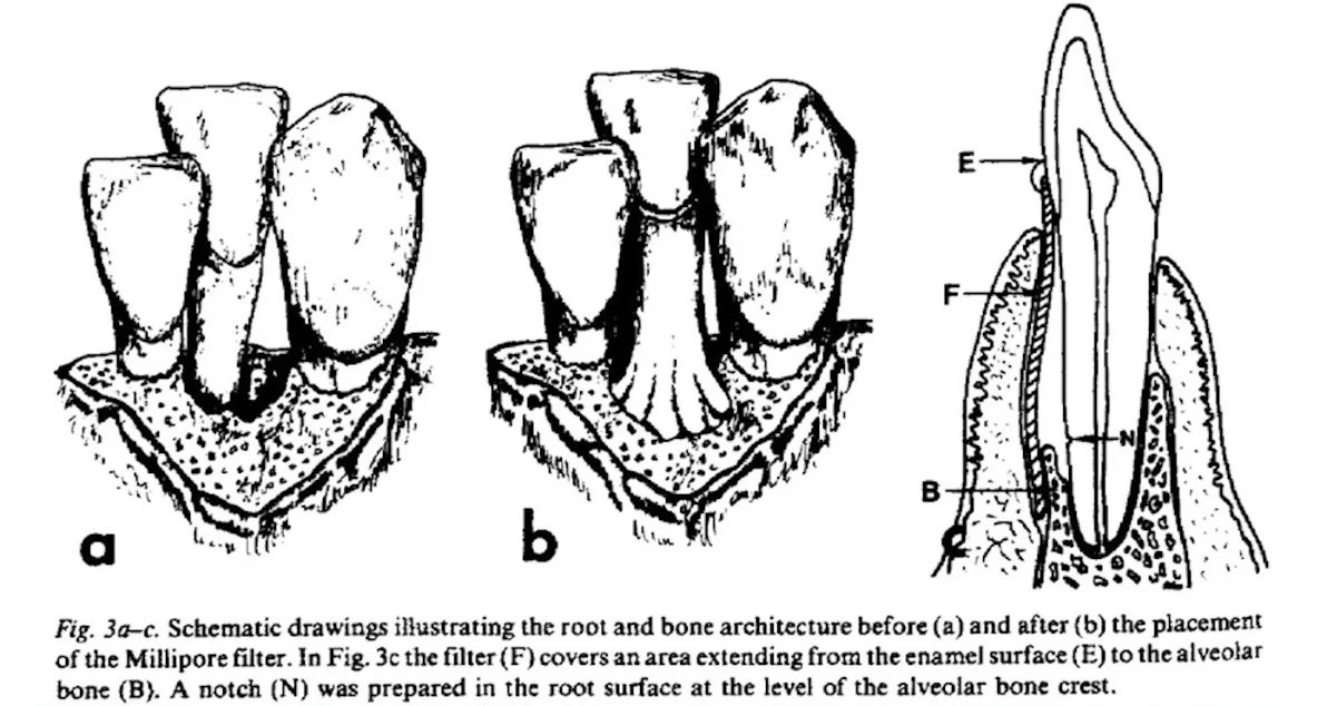 Schematic shows dr. Nyman's successful guided bone regeneration surgery technique.