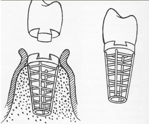 Dr. Ej greenfield's implant system - 1913