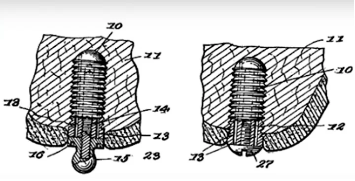 Dr. Adams implant system (1937)