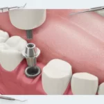How the implant/abutment connection affects soft tissue integration and marginal bone loss