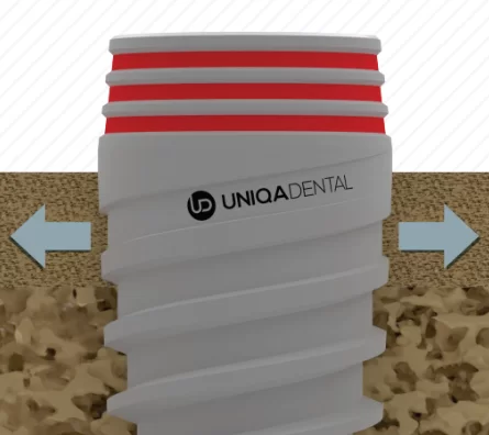 Varieties and sizes of dental implants from Uniqa Dental