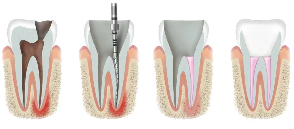 Illustration of tooth anatomy comparing root canal procedure and tissue regeneration stages.