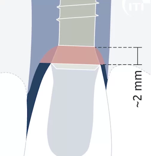 Width of the milled part of the implant of the tissue level type