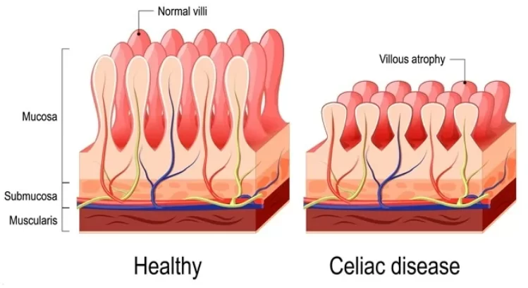 Intestinal villi - healthy and for celiac disease