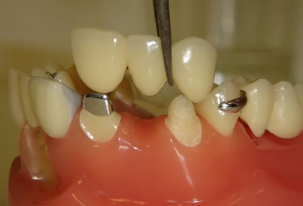 Dental implantation in systemic diseases: opportunities and limitations