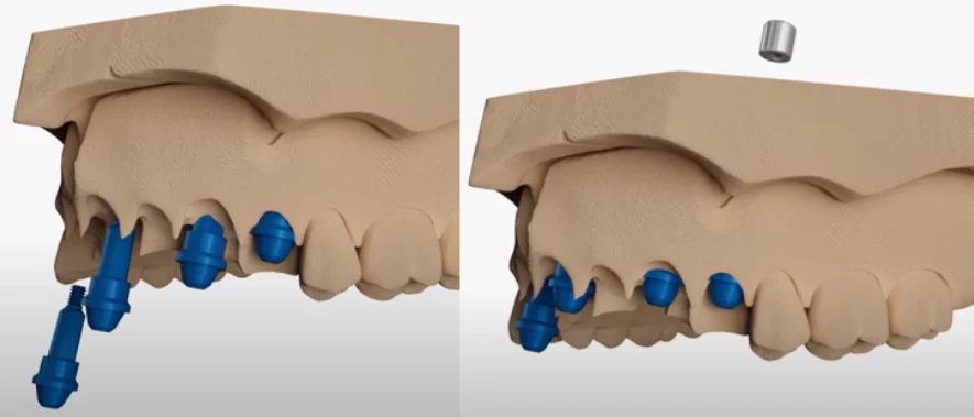 Installation of implant analogs into the jaw model