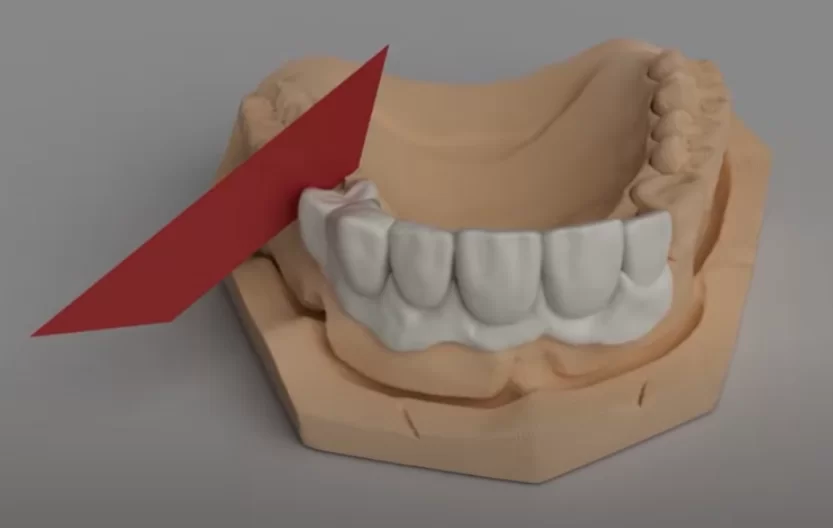 Sections to properly assess how the denture fits and how effectively the pressure is distributed