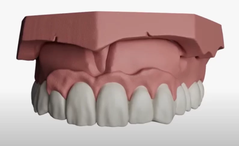 Complete screw-retained restoration of a tooth row