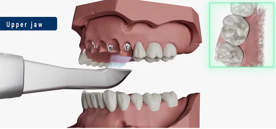 Scanning of the upper jaw without scan bodies