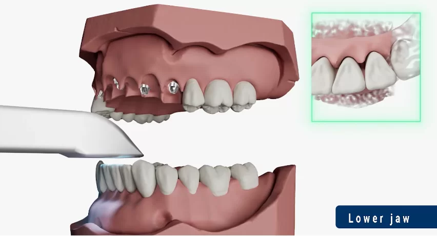 Scanning the lower jaw