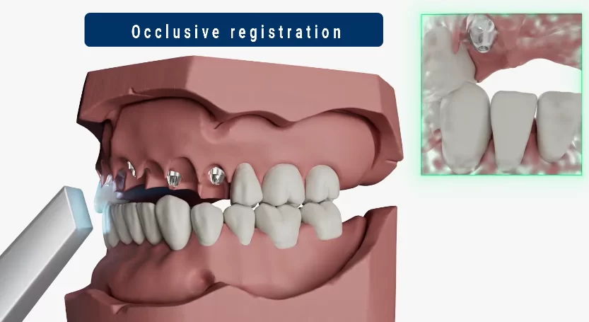 Scanning of the dentition along the occlusal plane