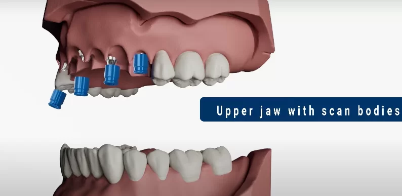 Installation of scan bodies on the virtual jaw model