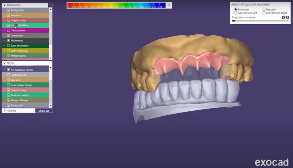 Creating a simulated gingiva that should fit tightly against the patient's soft tissues