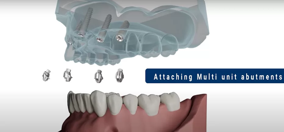 Virtual jaw model during the installation of the multi-unit abutments