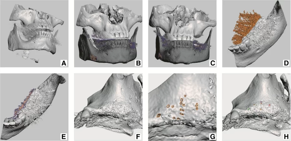 Image. 4 model preparation: a) newly generated bone tissue 3d model (mesh); b) model – fragments of vertebrae, hyoid bone and some noise were removed; c) maxilla and mandible have put into occlusion; d) mandible trimmed down to size necessary for work; e) more noise removed from mandible; f) maxilla presenting anatomical holes (apertures); g) “healing” anatomical holes in maxilla; h) “healed” maxilla, colour patches represent former anatomical holes