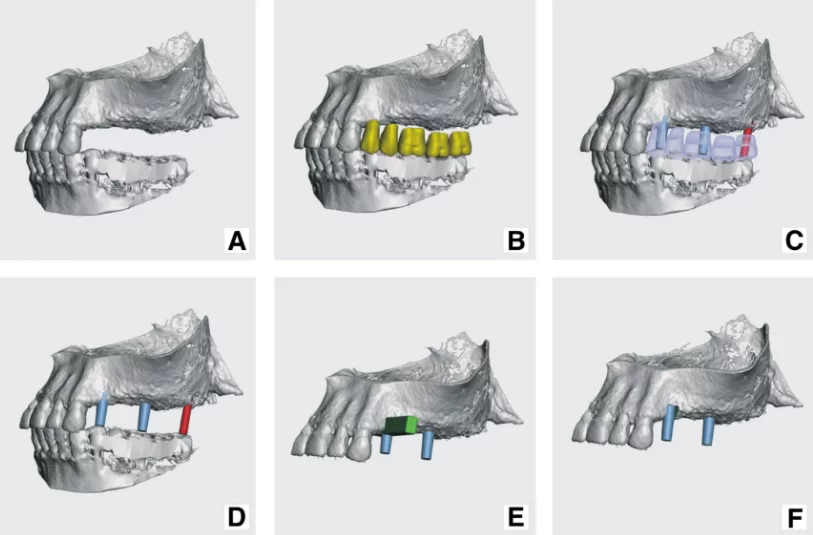 Image. 5 model preparation continued: a) virtual jaw models in occlusion; b) virtual teeth added; c) prospective abutments have been placed in places corresponding to future teeth; d) future abutments – sky blue abutments belong to subperiosteal implant and red one belongs to planned screw type implant; e) a cut-off tool placed in the area of tooth 24 (fdi), where abutment was planned to bury deeper into the bone; f) maxilla with cut-off and placed abutments