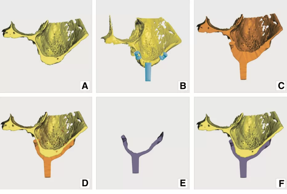 Image. 6 modeling principle: a) original model of the jaw; b) pre-made structures (loops and abutments) added on to virtual model; c) pre-made structures and modelled (bulked) implant merged with original model; d) the 2nd copy of original model (yellow) recalled and matched with model onto which implant was modelled (orange); e) implant – result of boolean operation, subtraction of yellow model form orange model; f) implant (resultant) model superimposed on the original jaw model. (screenshots from meshmixer program)