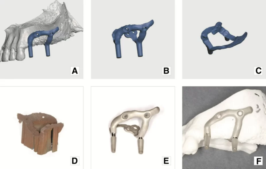 Image. 9 final result: a) implant digital model superimposed on the jaw virtual model; b) and c) implant digital model in different projections; d) implant with printing supports, immediately after production; e) implant with supports removed and mechanical grinding and polishing completed; f) subperiosteal implant on the plastic model of maxilla
