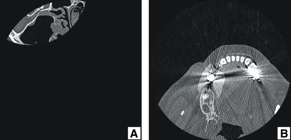 Fig 1 ct errors: a ) incomplete image; b ) x-ray scattering artifacts from metal objects in the patient's tissues and cavities