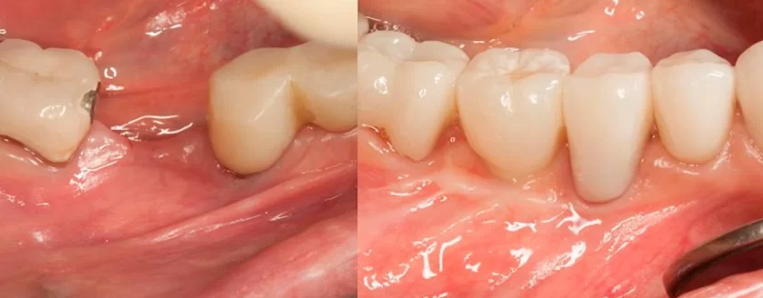 Problem area for implant installation with insufficient attached keratinized gingiva