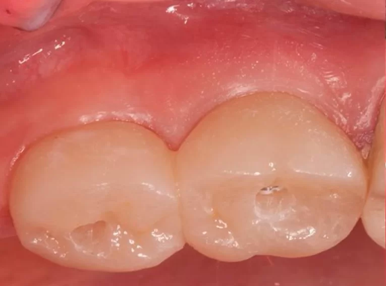 Vestibular view of the restoration showing the keratinized gingiva and the mucogingival line