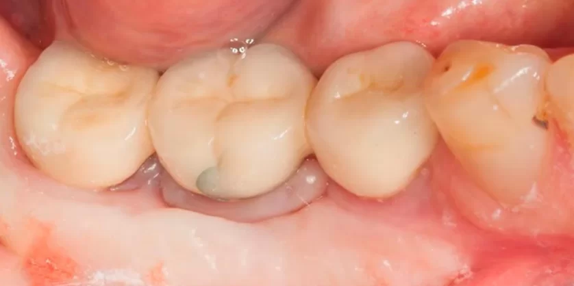 Problematic soft tissue that indicates an inflammatory process in the implant area