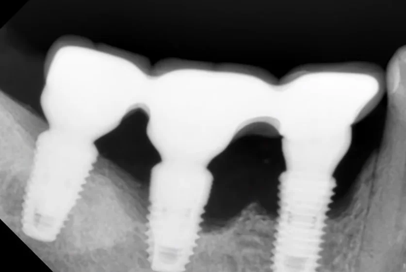 X-ray image of severe peri-implantitis
