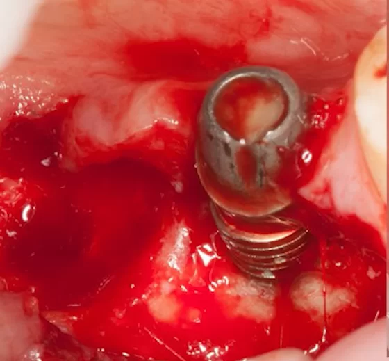 If there is significant bone resorption caused by peri-implantitis, i the presence of a dense keratinized gingiva is irrelevant because it is not attached to anything