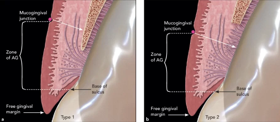 Healthy tooth with the mgj apical to the bone crest. Part a of the new definition. The ag is from the base of the sulcus to the mgj. (a) type 1. The ag is attached via the junctional epithelium, connective tissue fibers, and periosteum over bone. (b) type 2. The ag is attached via the junctional epithelium and connective tissue fibers, but is not attached to the bone.