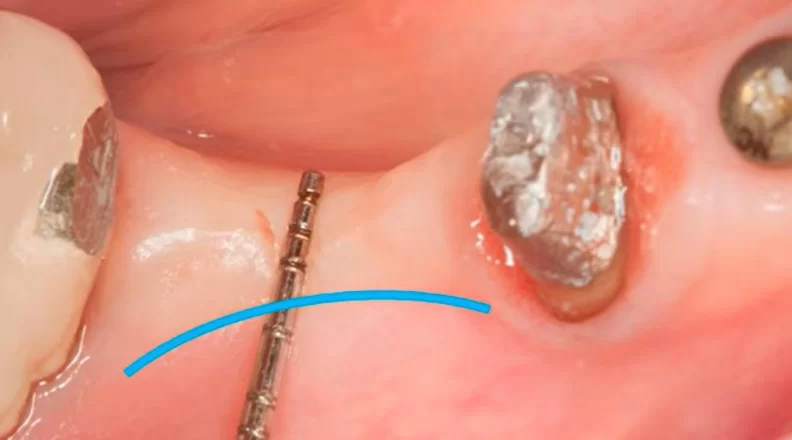 Keratinized gingival deficiency after bone augmentation and implant installation