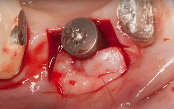 Implant opening with displacement of a keratinized gingival flap
