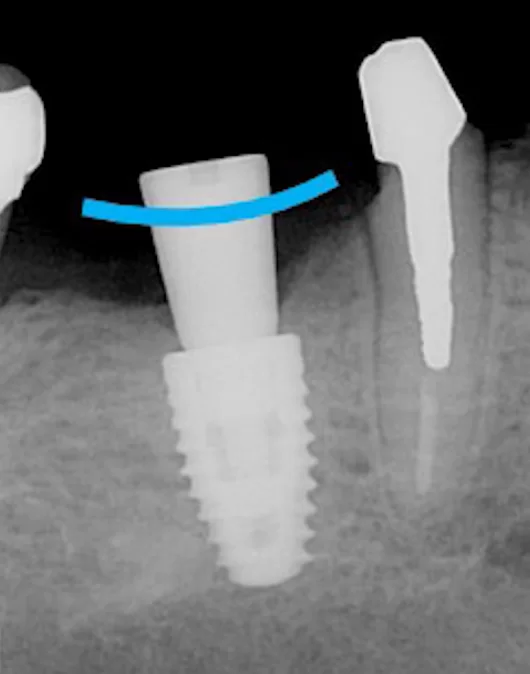 The x-ray shows that the mucogingival line is well above the alveolar crest