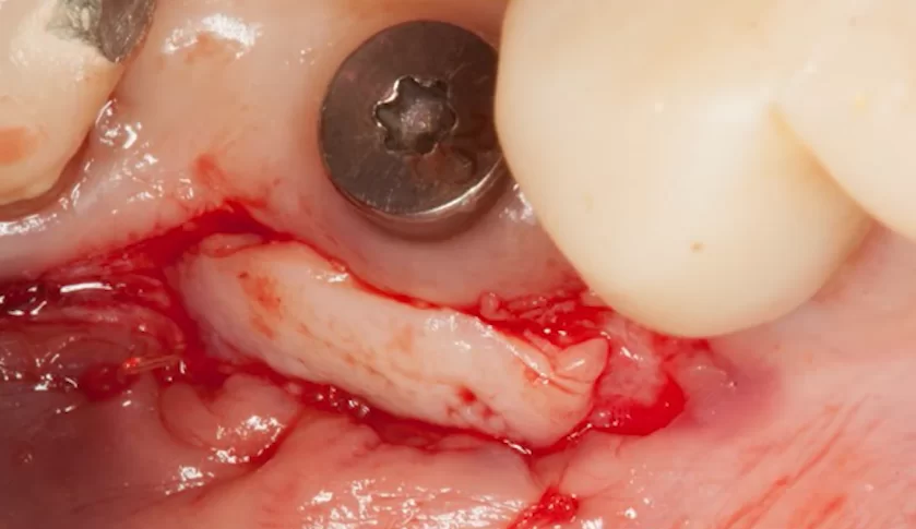 Transplantation of keratinized gingiva taken from the palate