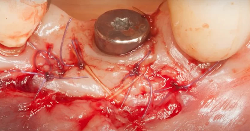 Final operation of keratinized gingiva transplant surgery