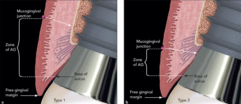 Tissue-level implant with the mgj apical to the bone crest. Part a of the new definition. The ag is from the base of the sulcus to the mgj. (a) type 1. The ag is attached via the junctional epithelium, connective tissue fibers, and periosteum over bone. (b) type 2. The ag is attached via the junctional epithelium and the connective tissue fibers, but is not attached to the bone.