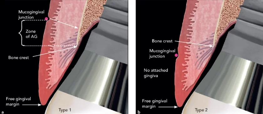 Peri-implantitis on a tissue-level implant. The mgj is apical to the bone crest. (a) type 1. The zone of ag is measured from the crest of the bone to the mgj, attached only to the bone and not to the tooth. (b) type 2. There is no ag, only a zone of keratinized tissue.