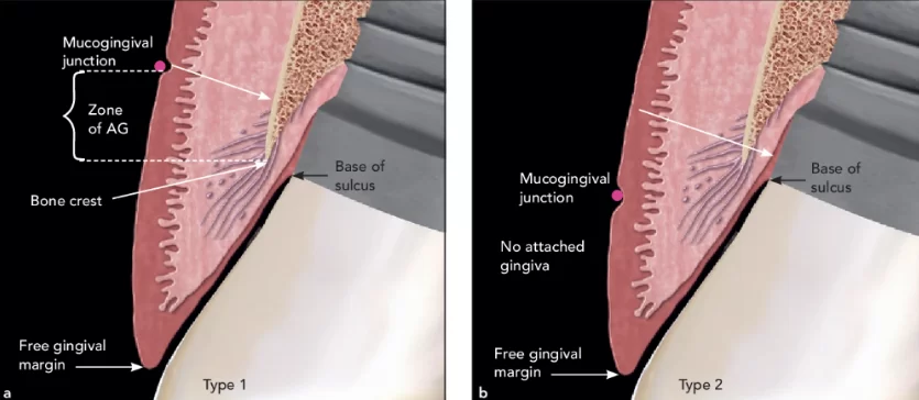 Healthy bone-level implants. The mgj is apical to the bone crest. (a) type 1. The zone of ag is measured from the bone crest to the mgj, attached only to the bone and not to the tooth. (b) type 2. There is no ag, only a zone of keratinized tissue.