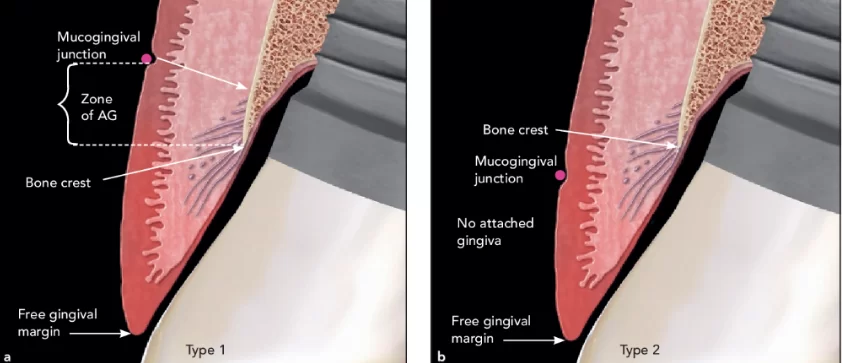 Peri-implantitis on bone-level implants. (a) type 1. The mgj is apical to the bone crest. Ag is measured from the bone crest to the mgj, attached only to the bone and not to the tooth. (b) type 2. The mgj is coronal to the bone crest, and therefore there is no ag, only a zone of keratinized tissue.
