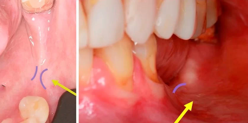 Keratinized gingival deficiency with insufficient attachment